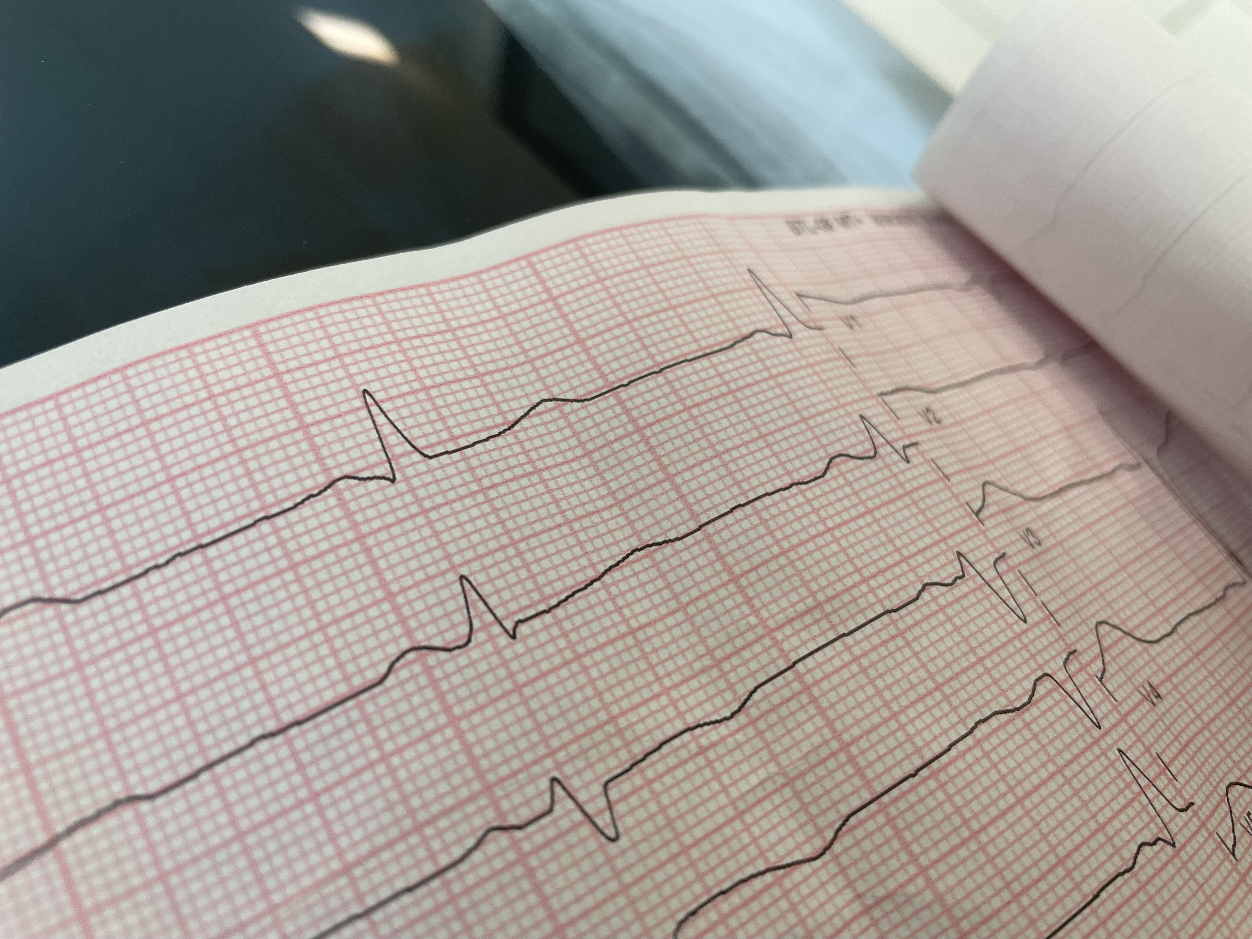 Более 94 тысяч жителей ЗКО состоят на учете с болезнями сердца