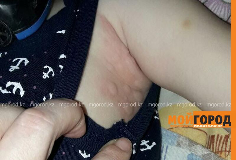 Уральские врачи не могут справиться с аллергией у 3-летнего ребенка