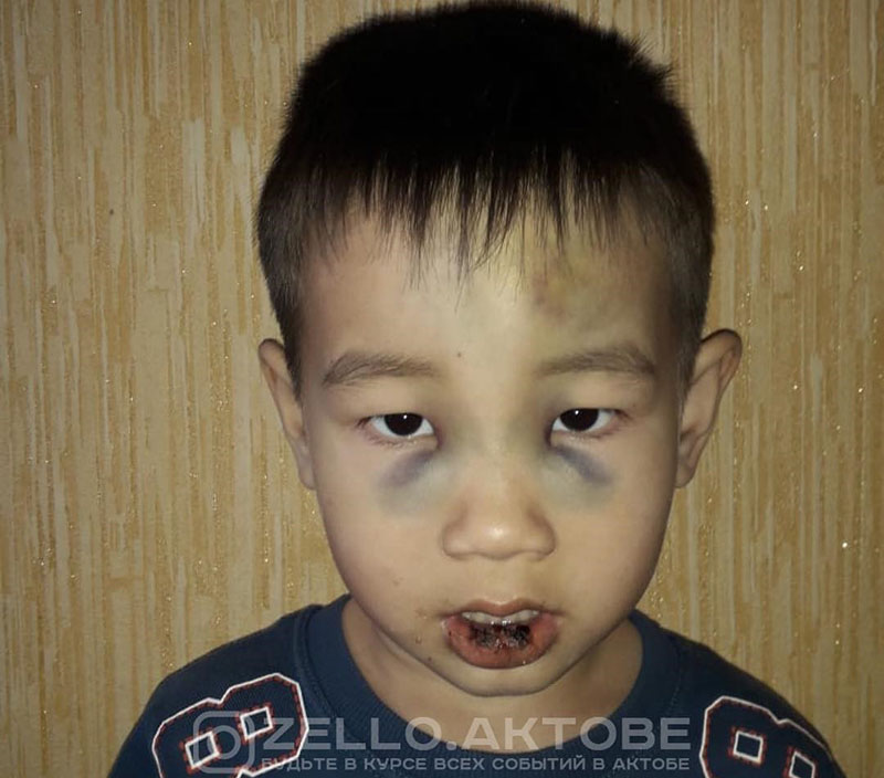 В Актобе 6-летний ребенок в школе порвал губу и получил синяки