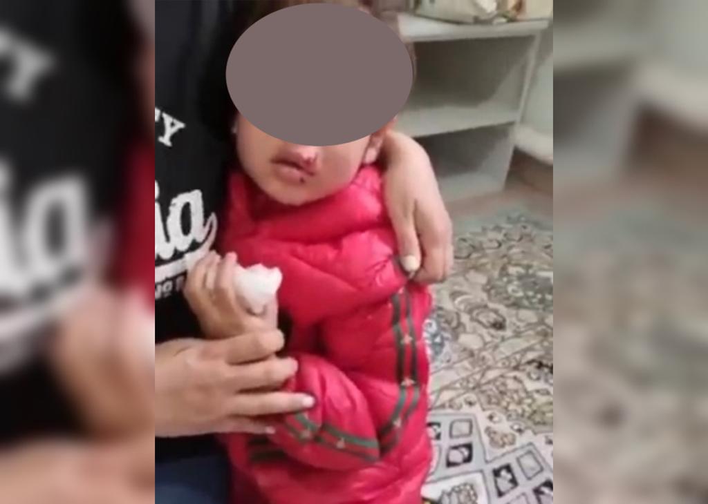 В Атырау 5-летнюю девочку в лицо укусила собака