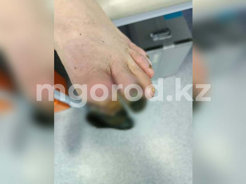 Житель ЗКО месяц ходил с обмороженными пальцами