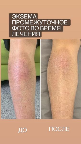 Победить рак возможно даже на крайних стадиях