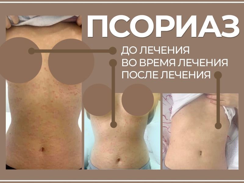 Победить рак возможно даже на крайних стадиях